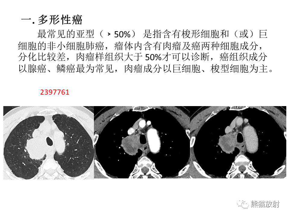 影像PPT - 【病例】肺肉瘤样癌2例CT影像-35