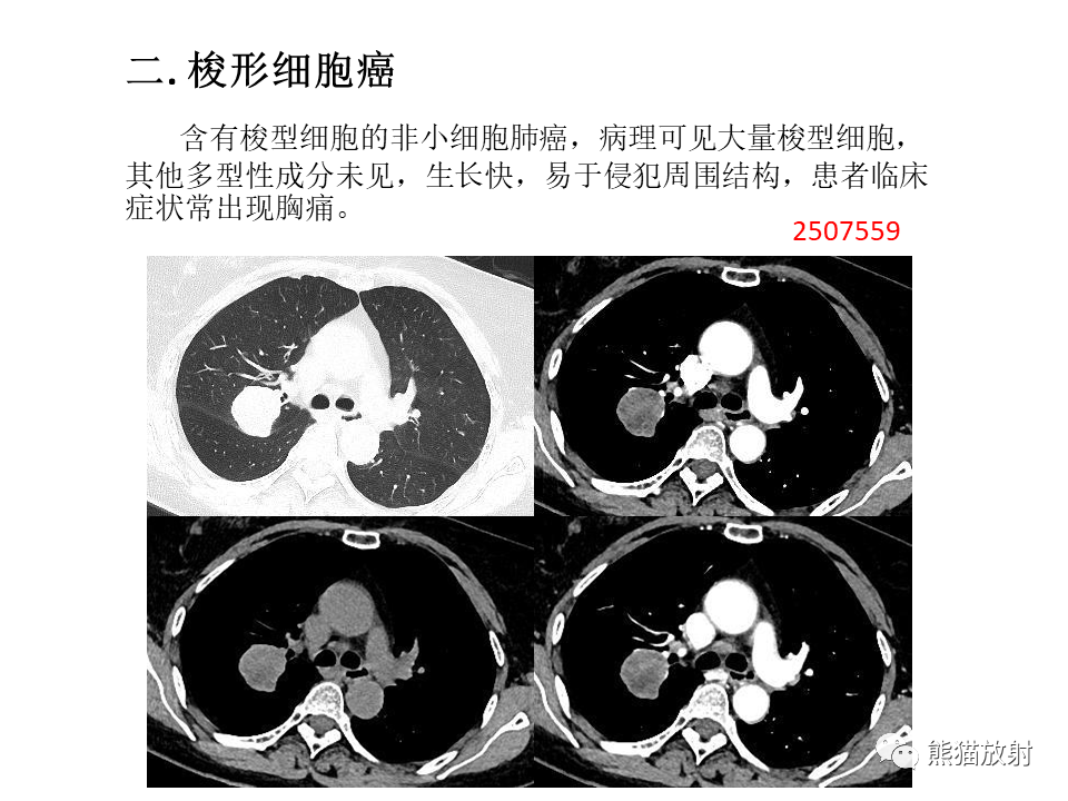 影像PPT - 【病例】肺肉瘤样癌2例CT影像-36