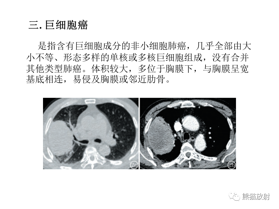 影像PPT - 【病例】肺肉瘤样癌2例CT影像-37
