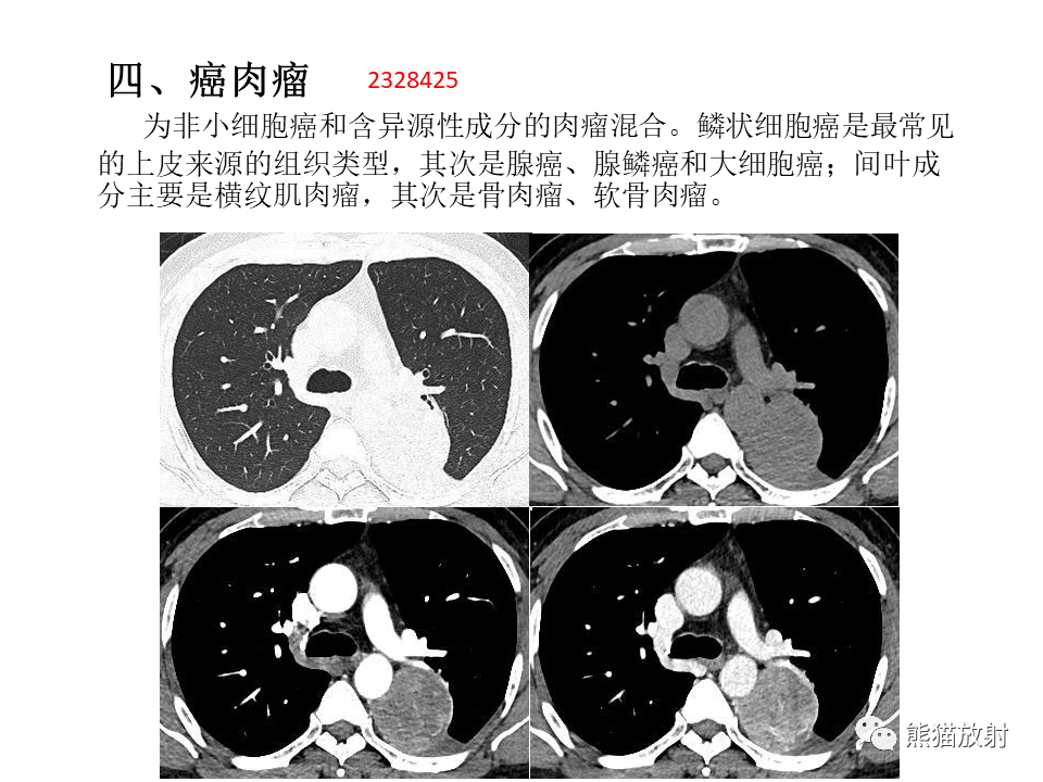 影像PPT - 【病例】肺肉瘤样癌2例CT影像-38