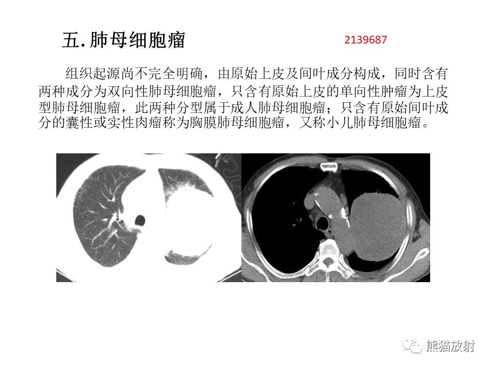 影像PPT - 【病例】肺肉瘤样癌2例CT影像-39