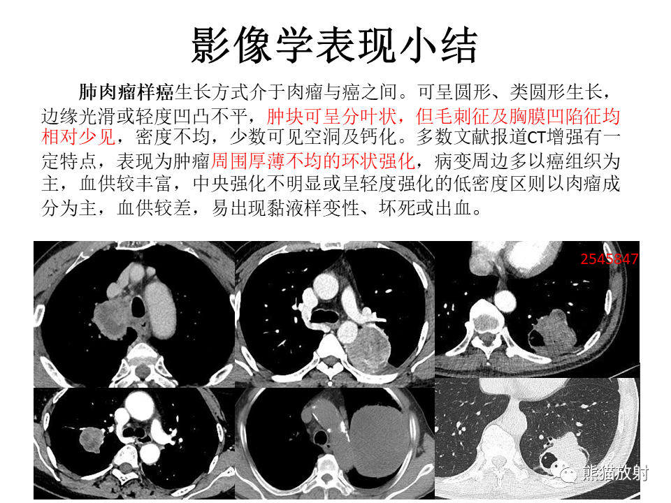 影像PPT - 【病例】肺肉瘤样癌2例CT影像-40
