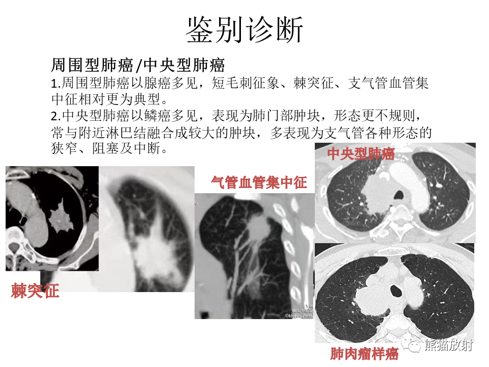 影像PPT - 【病例】肺肉瘤样癌2例CT影像-41