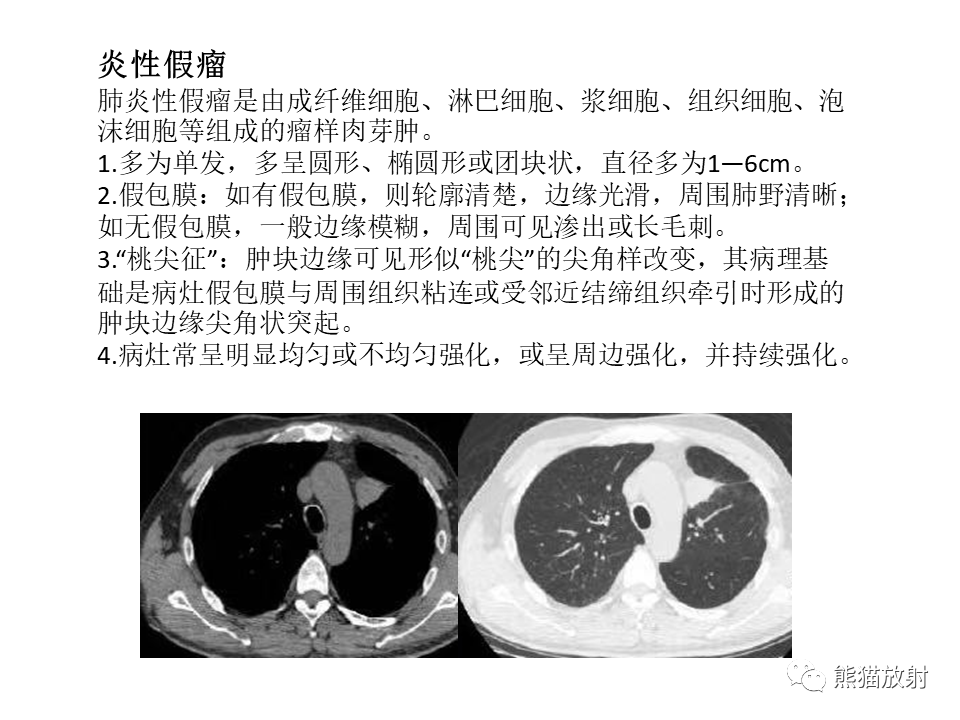影像PPT - 【病例】肺肉瘤样癌2例CT影像-42