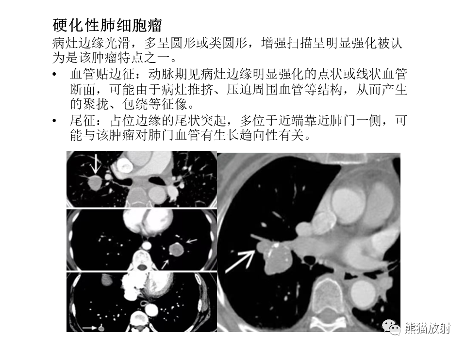 影像PPT - 【病例】肺肉瘤样癌2例CT影像-44