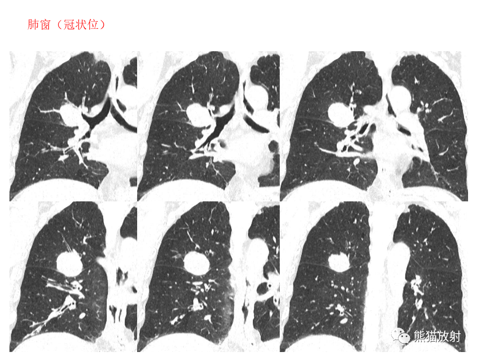影像PPT - 【病例】肺肉瘤样癌2例CT影像-3