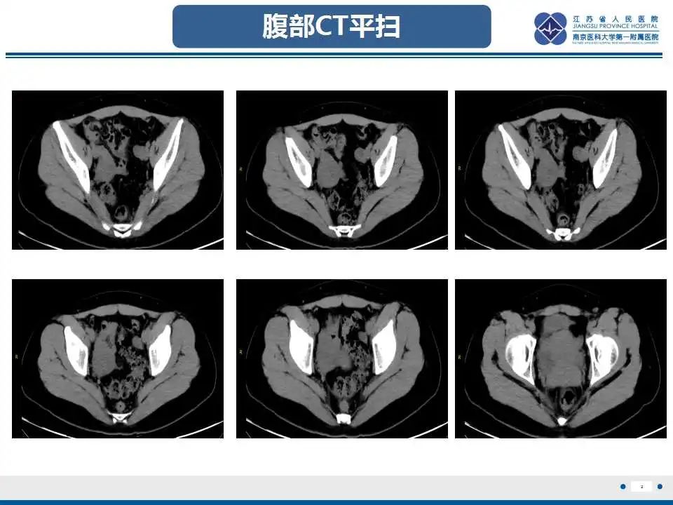 影像PPT - 【PPT】卵巢支持细胞瘤-3