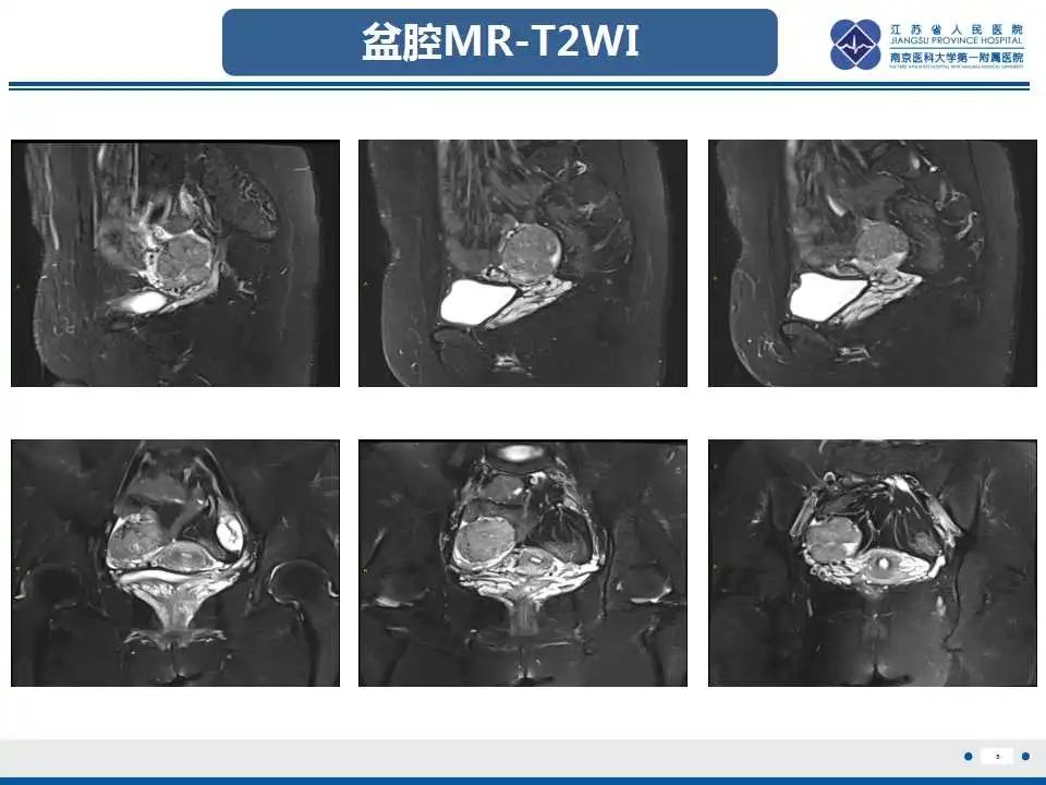 影像PPT - 【PPT】卵巢支持细胞瘤-6