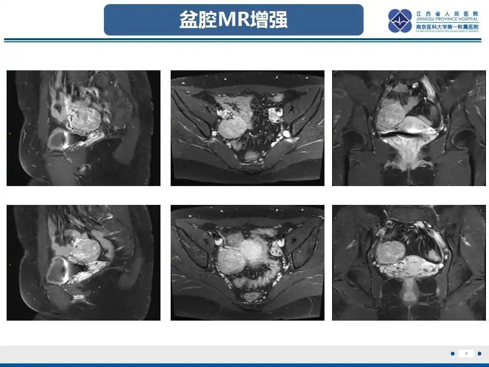 影像PPT - 【PPT】卵巢支持细胞瘤-8
