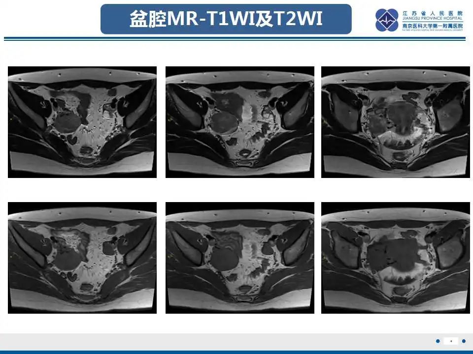 影像PPT - 【PPT】卵巢支持细胞瘤-5