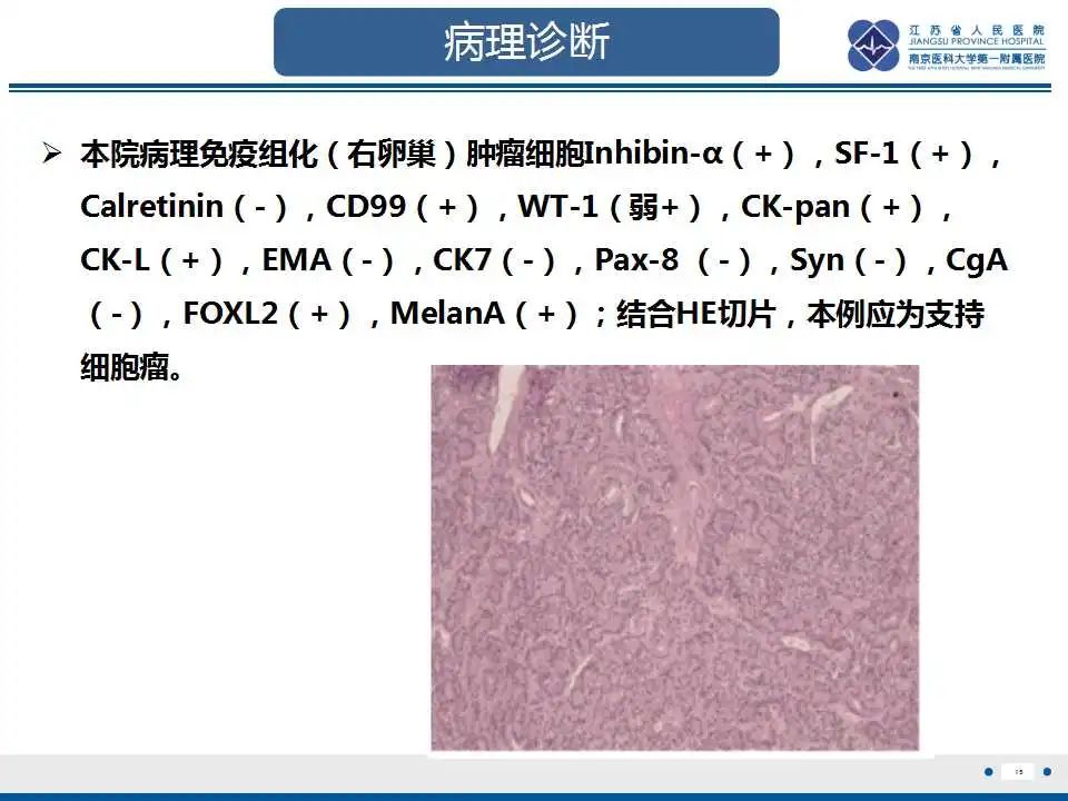 影像PPT - 【PPT】卵巢支持细胞瘤-16
