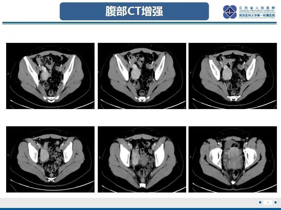 影像PPT - 【PPT】卵巢支持细胞瘤-4