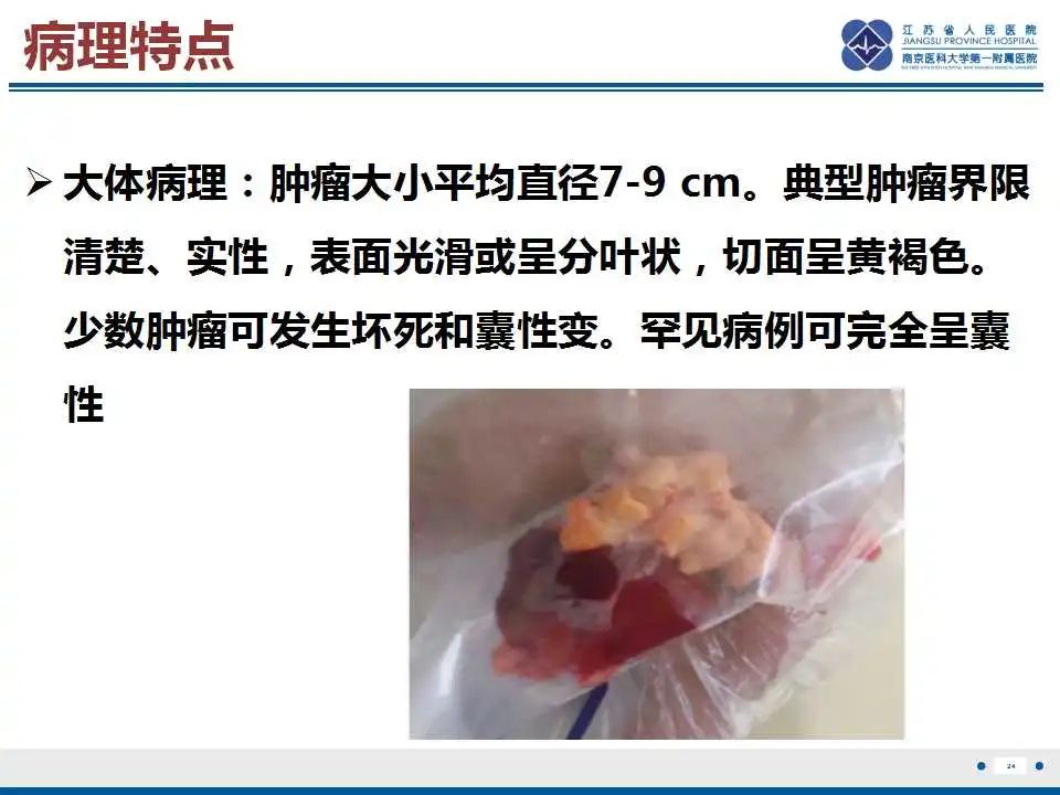 影像PPT - 【PPT】卵巢支持细胞瘤-25