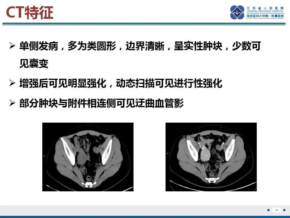 影像PPT - 【PPT】卵巢支持细胞瘤-27