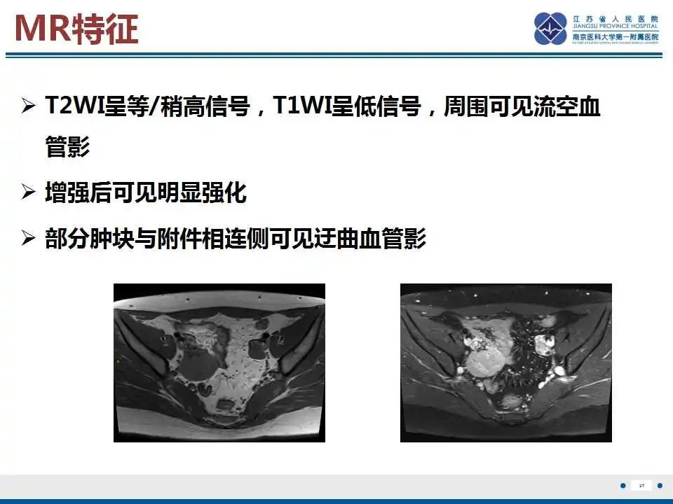影像PPT - 【PPT】卵巢支持细胞瘤-28