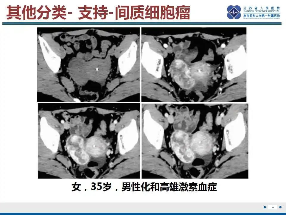 影像PPT - 【PPT】卵巢支持细胞瘤-31