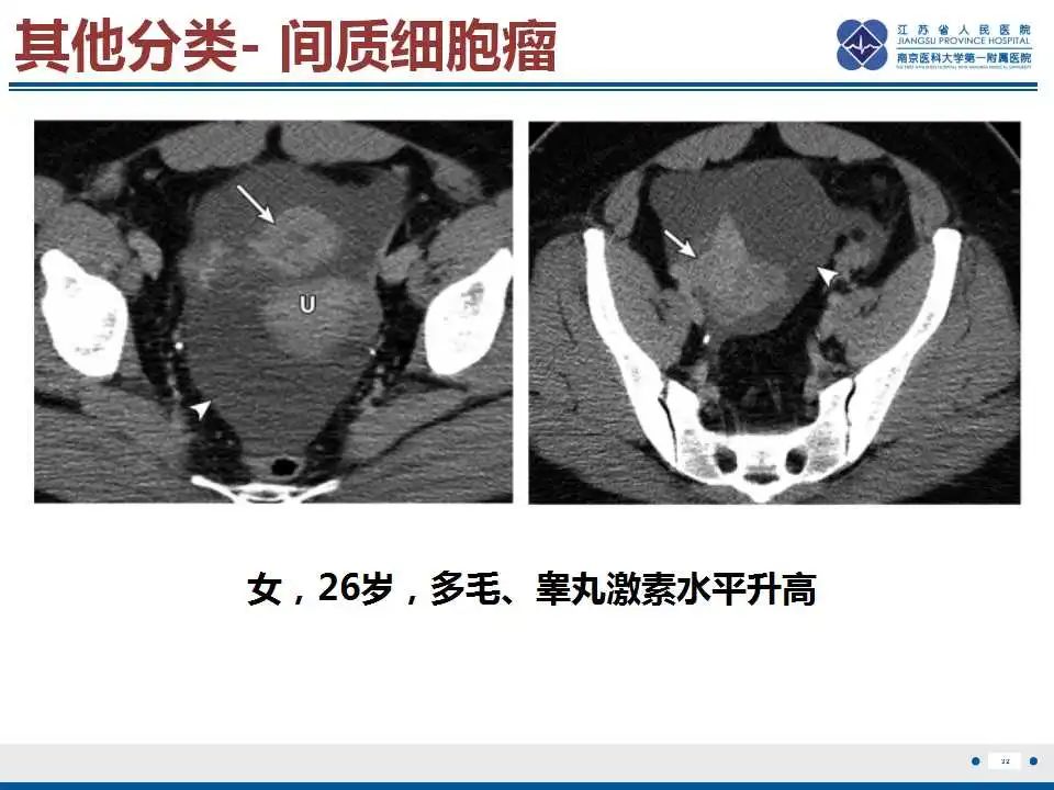 影像PPT - 【PPT】卵巢支持细胞瘤-33