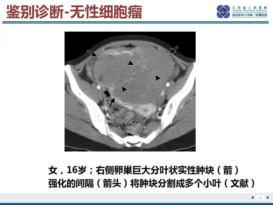 影像PPT - 【PPT】卵巢支持细胞瘤-35
