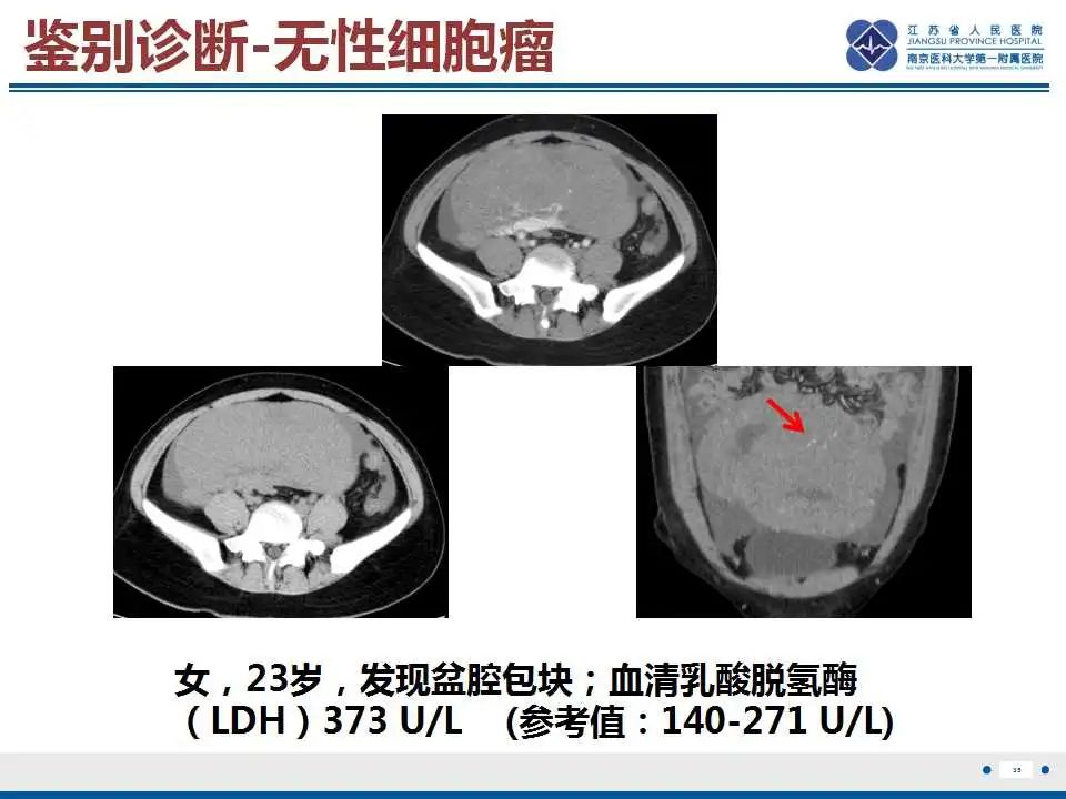 影像PPT - 【PPT】卵巢支持细胞瘤-36