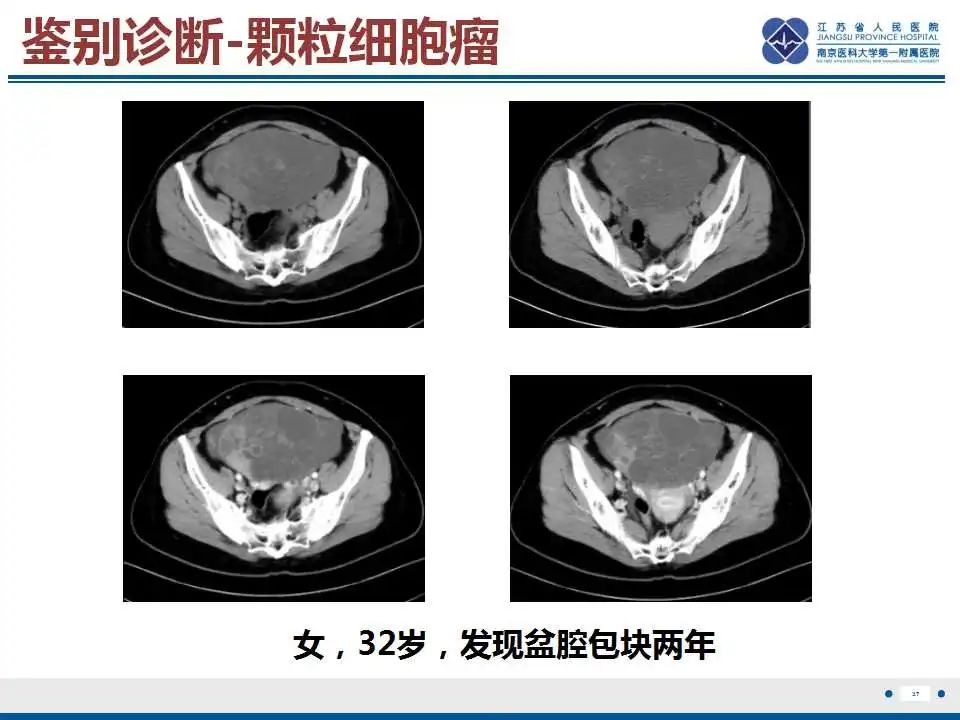 影像PPT - 【PPT】卵巢支持细胞瘤-38