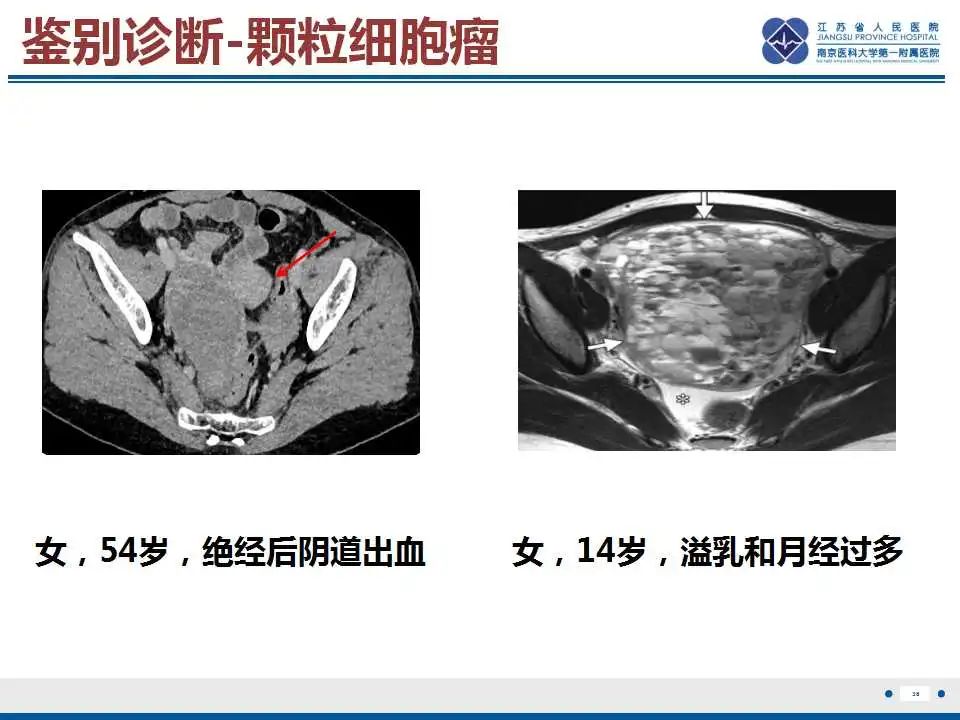 影像PPT - 【PPT】卵巢支持细胞瘤-39