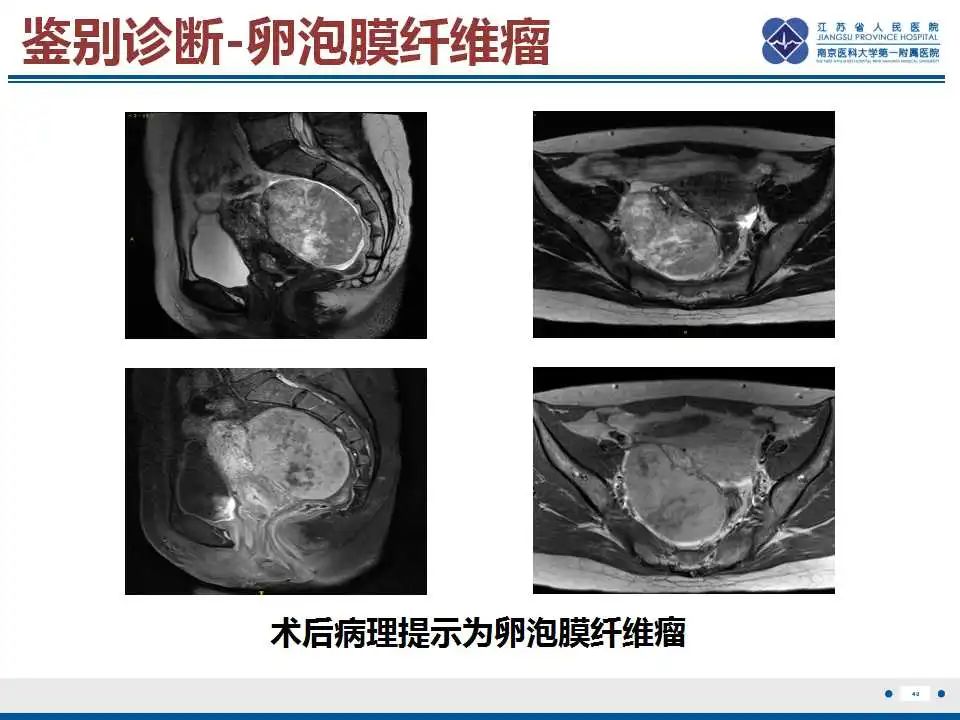 影像PPT - 【PPT】卵巢支持细胞瘤-41