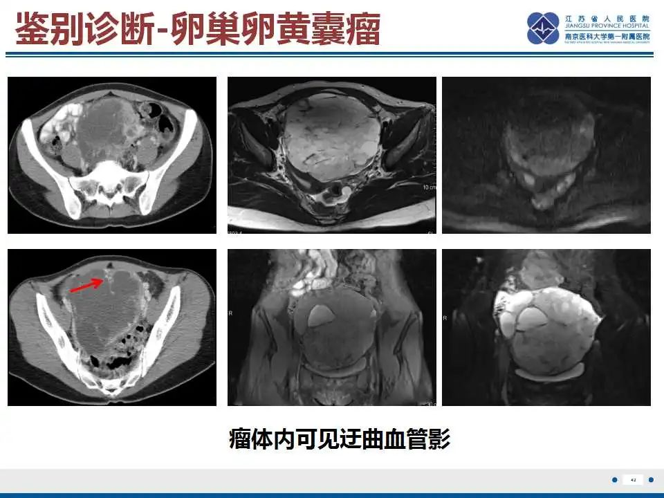 影像PPT - 【PPT】卵巢支持细胞瘤-43