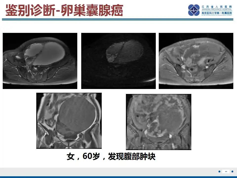 影像PPT - 【PPT】卵巢支持细胞瘤-45