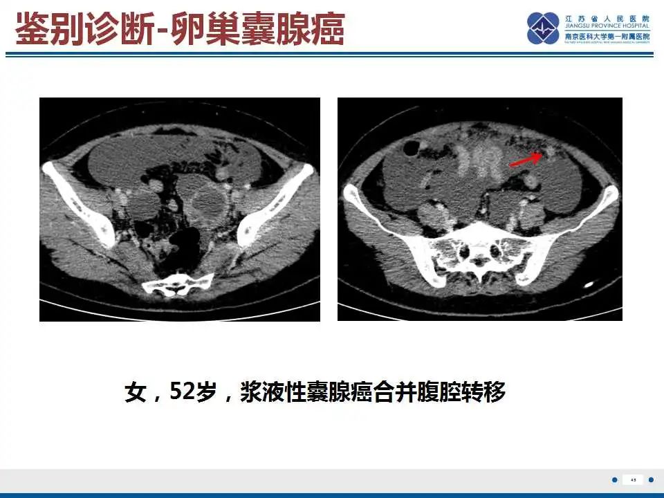 影像PPT - 【PPT】卵巢支持细胞瘤-46