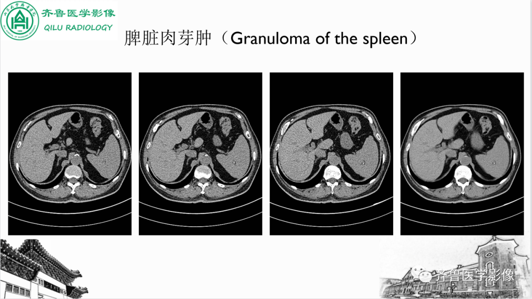 影像PPT - 【PPT】脾脏钙化相关性疾病-15