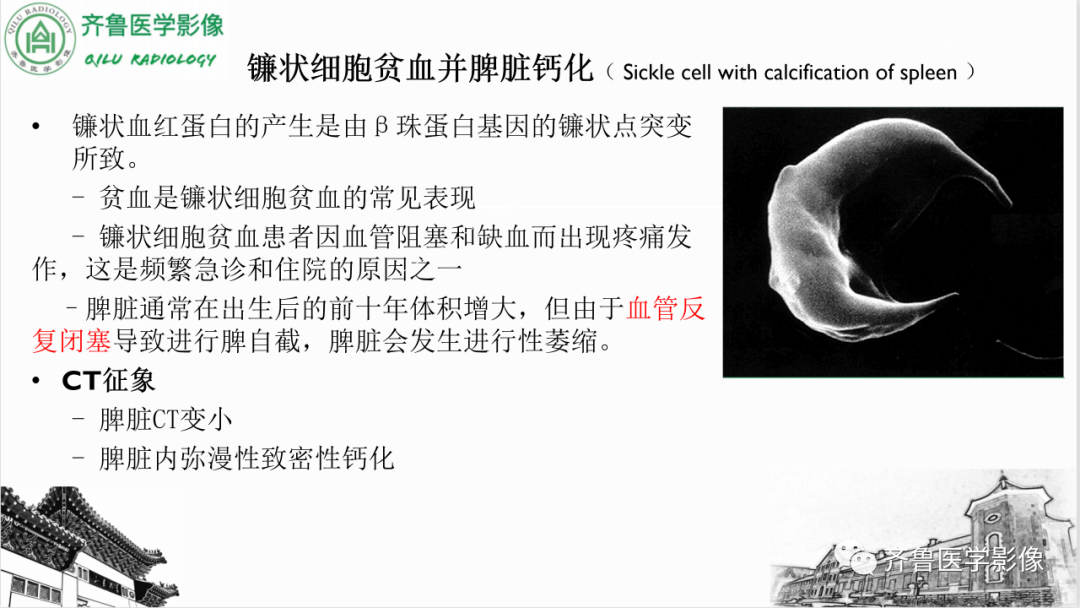 影像PPT - 【PPT】脾脏钙化相关性疾病-32