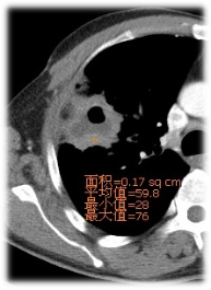影像PPT - 肺真菌感染与细菌感染、病毒感染的鉴别-7 影像PPT - 肺真菌感染与细菌感染、病毒感染的鉴别-7