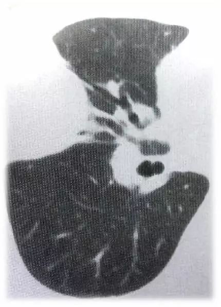 影像PPT - 肺真菌感染与细菌感染、病毒感染的鉴别-4 影像PPT - 肺真菌感染与细菌感染、病毒感染的鉴别-4