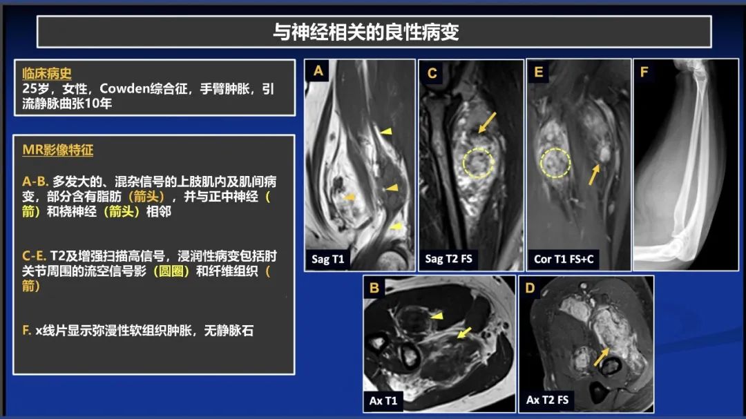 影像PPT - 【PPT】除了神经鞘瘤和神经纤维瘤：与神经相关的良性和恶性病变综述-9