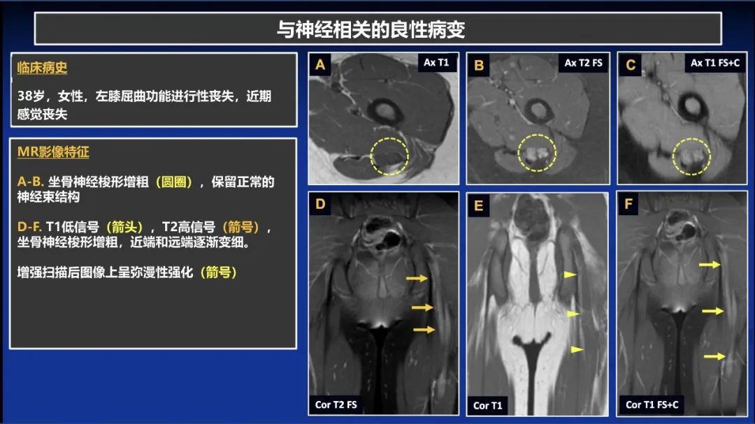 影像PPT - 【PPT】除了神经鞘瘤和神经纤维瘤：与神经相关的良性和恶性病变综述-13