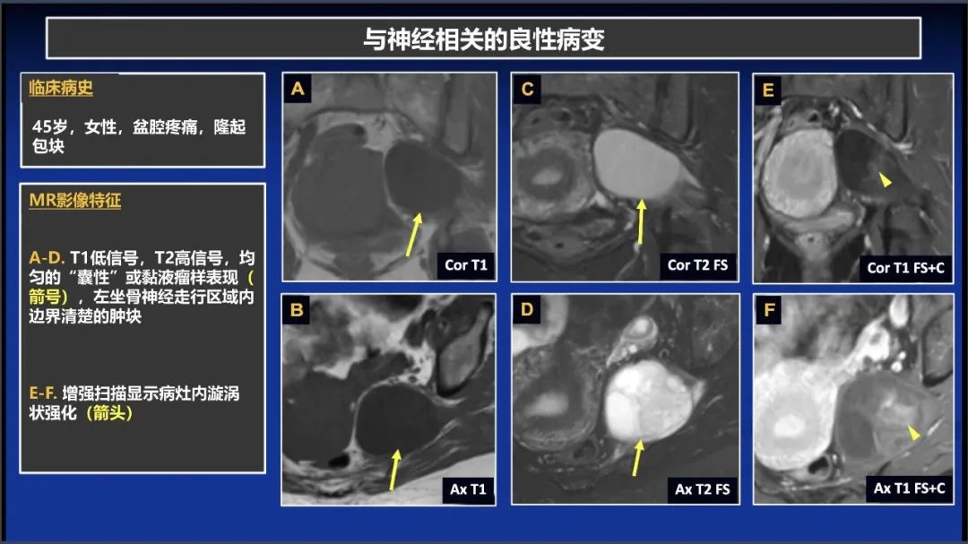 影像PPT - 【PPT】除了神经鞘瘤和神经纤维瘤：与神经相关的良性和恶性病变综述-5