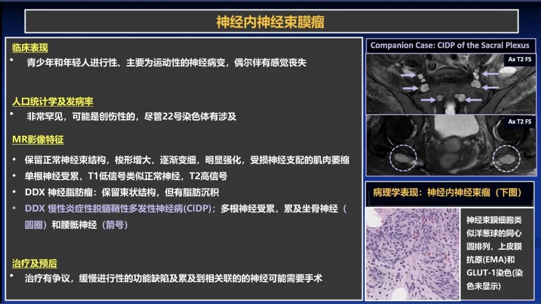 影像PPT - 【PPT】除了神经鞘瘤和神经纤维瘤：与神经相关的良性和恶性病变综述-15