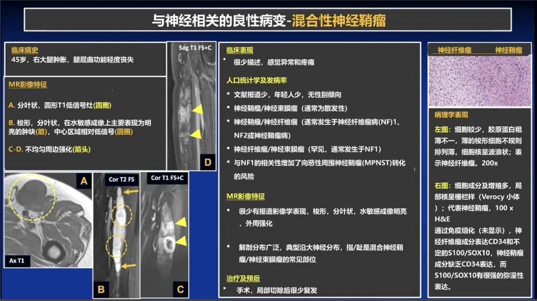 影像PPT - 【PPT】除了神经鞘瘤和神经纤维瘤：与神经相关的良性和恶性病变综述-17
