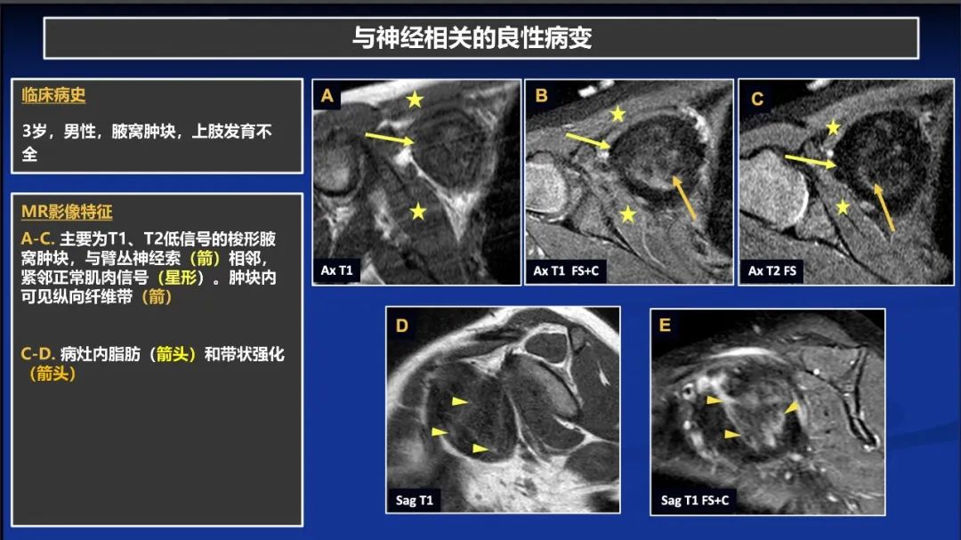 影像PPT - 【PPT】除了神经鞘瘤和神经纤维瘤：与神经相关的良性和恶性病变综述-19