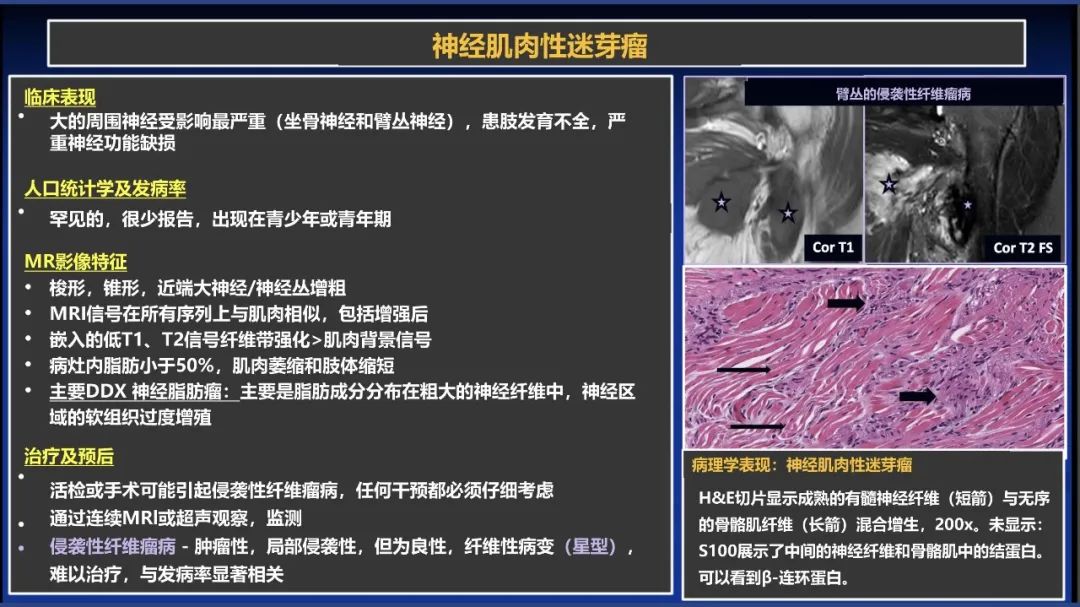 影像PPT - 【PPT】除了神经鞘瘤和神经纤维瘤：与神经相关的良性和恶性病变综述-21