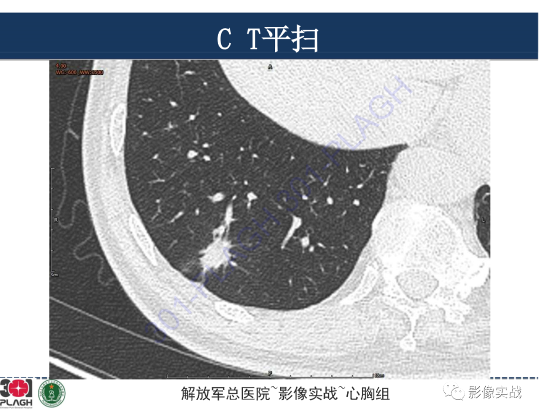 影像PPT - 【病例】肺浸润性腺癌1例CT影像-5