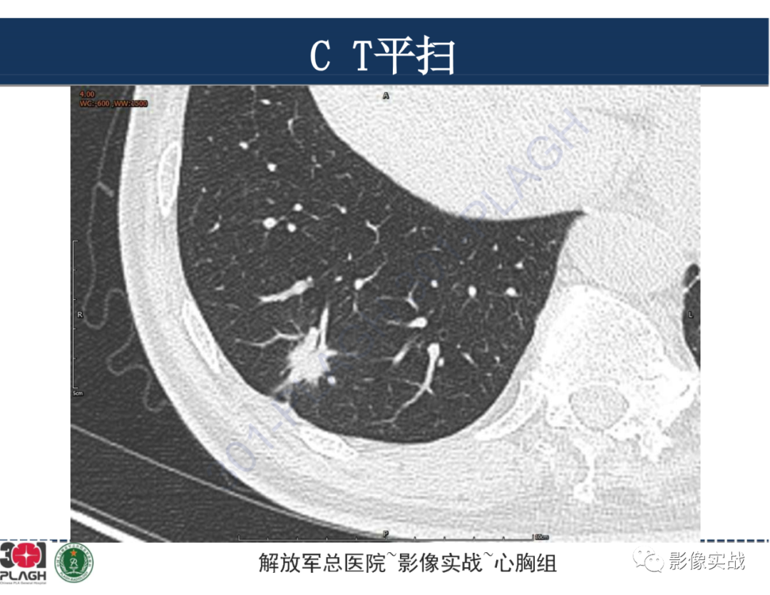 影像PPT - 【病例】肺浸润性腺癌1例CT影像-6