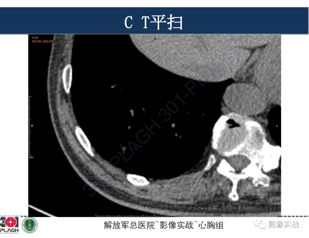 影像PPT - 【病例】肺浸润性腺癌1例CT影像-10