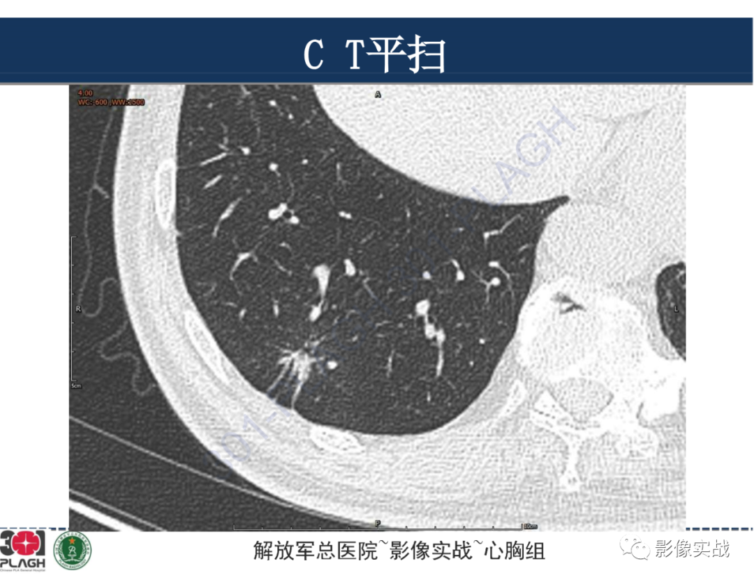 影像PPT - 【病例】肺浸润性腺癌1例CT影像-4