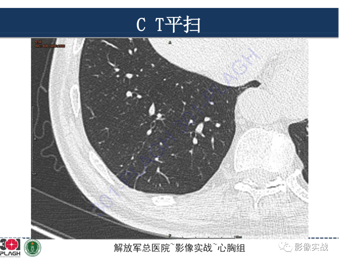 影像PPT - 【病例】肺浸润性腺癌1例CT影像-3