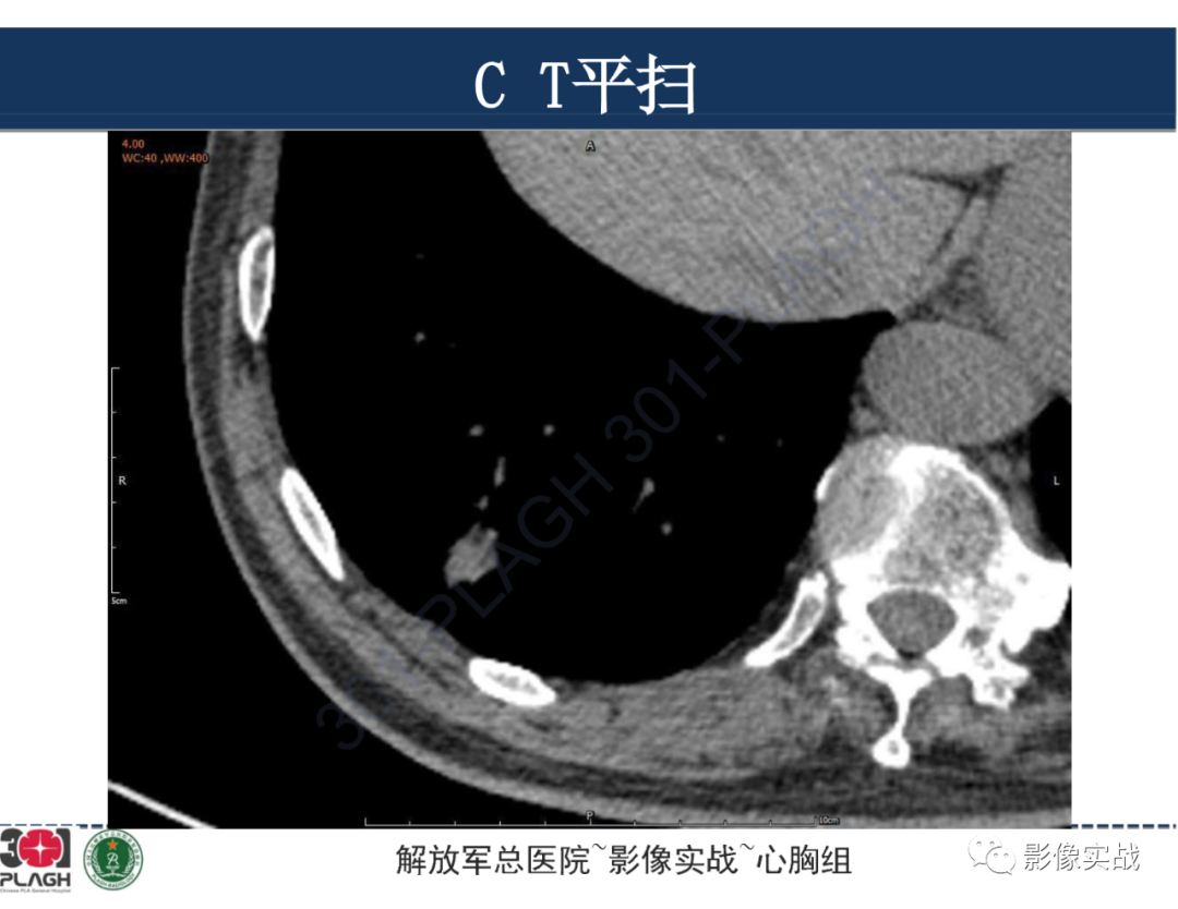 影像PPT - 【病例】肺浸润性腺癌1例CT影像-11