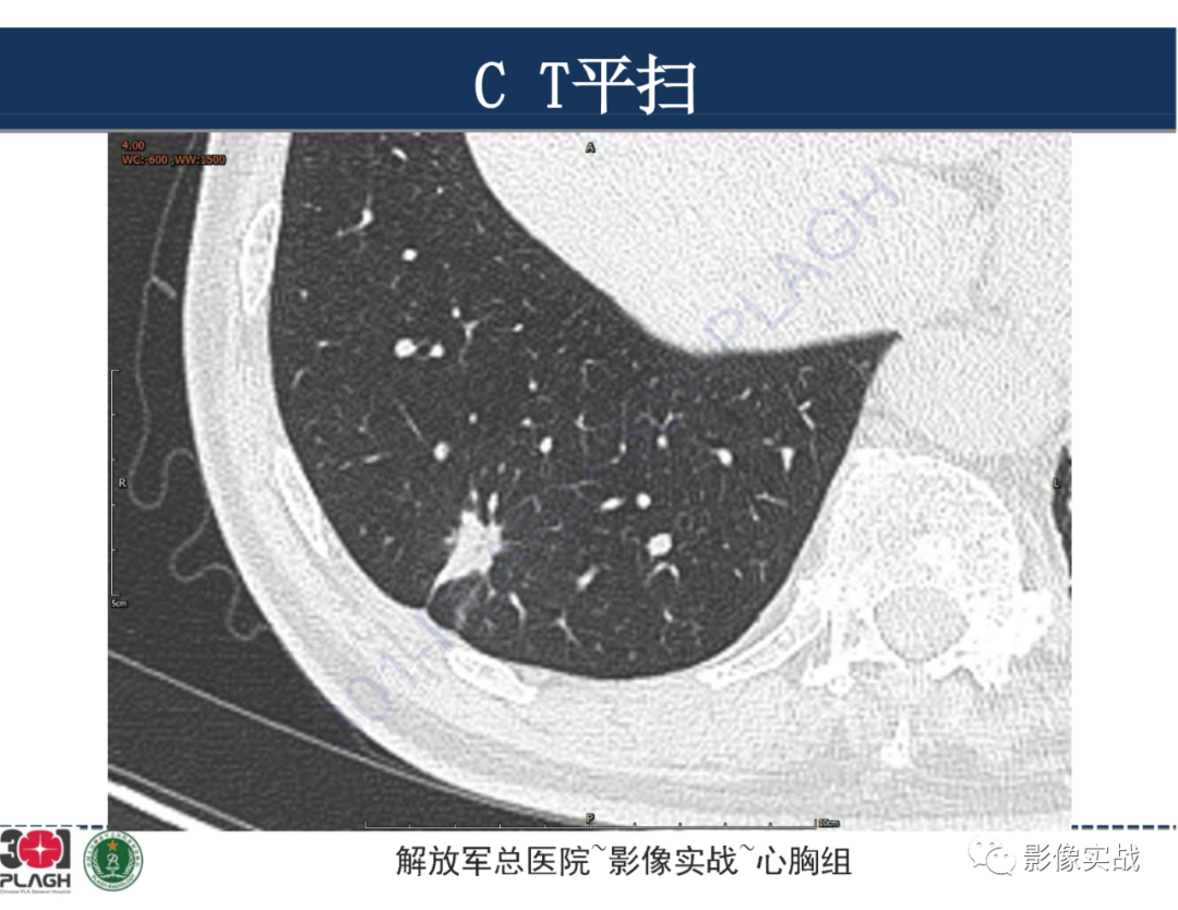 影像PPT - 【病例】肺浸润性腺癌1例CT影像-7