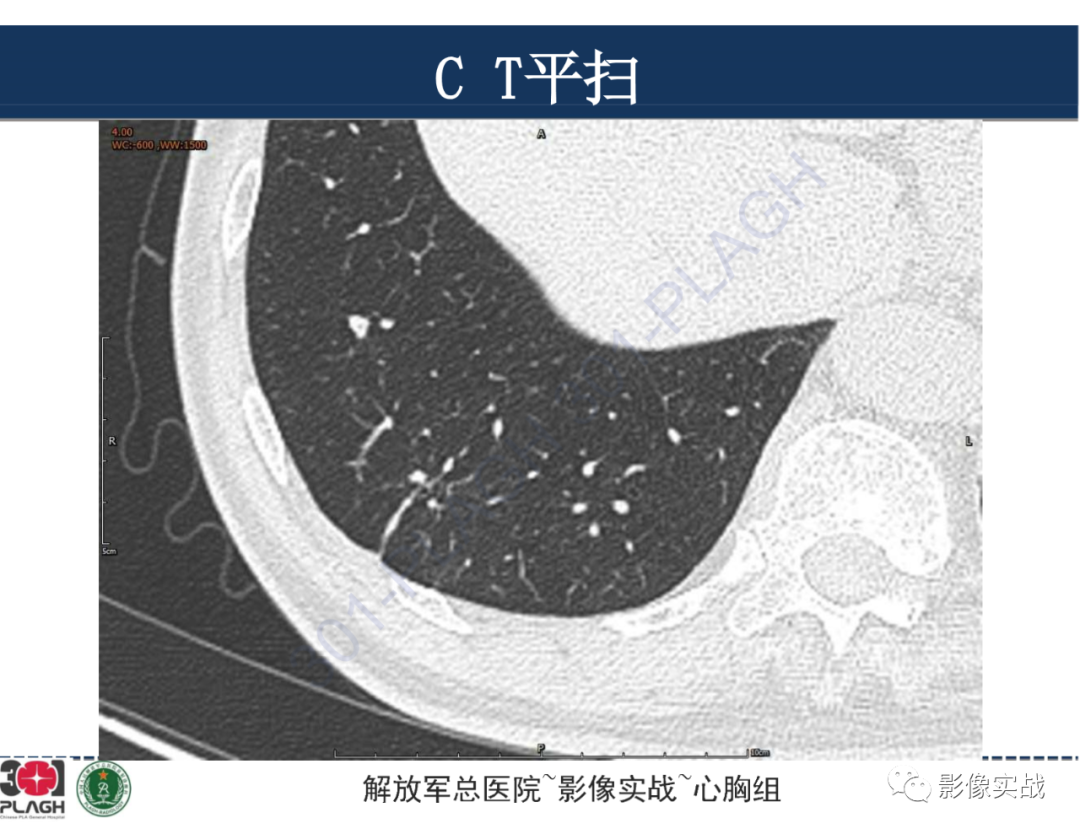 影像PPT - 【病例】肺浸润性腺癌1例CT影像-8