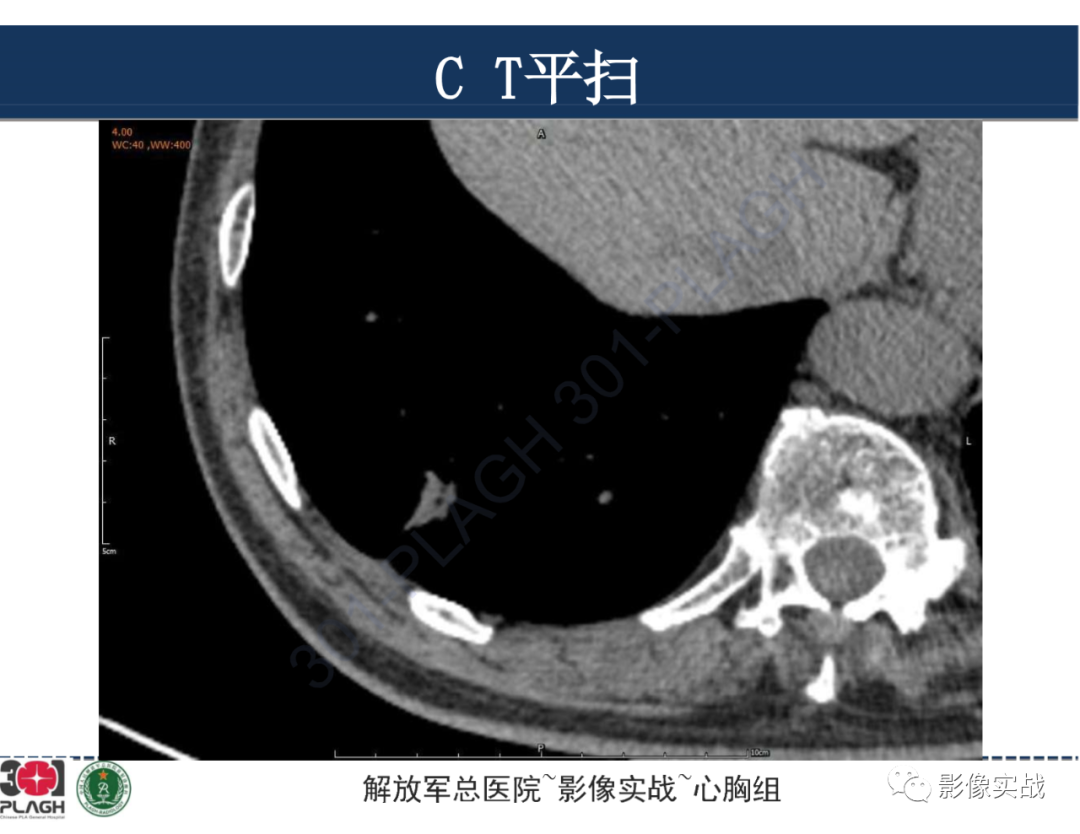 影像PPT - 【病例】肺浸润性腺癌1例CT影像-13