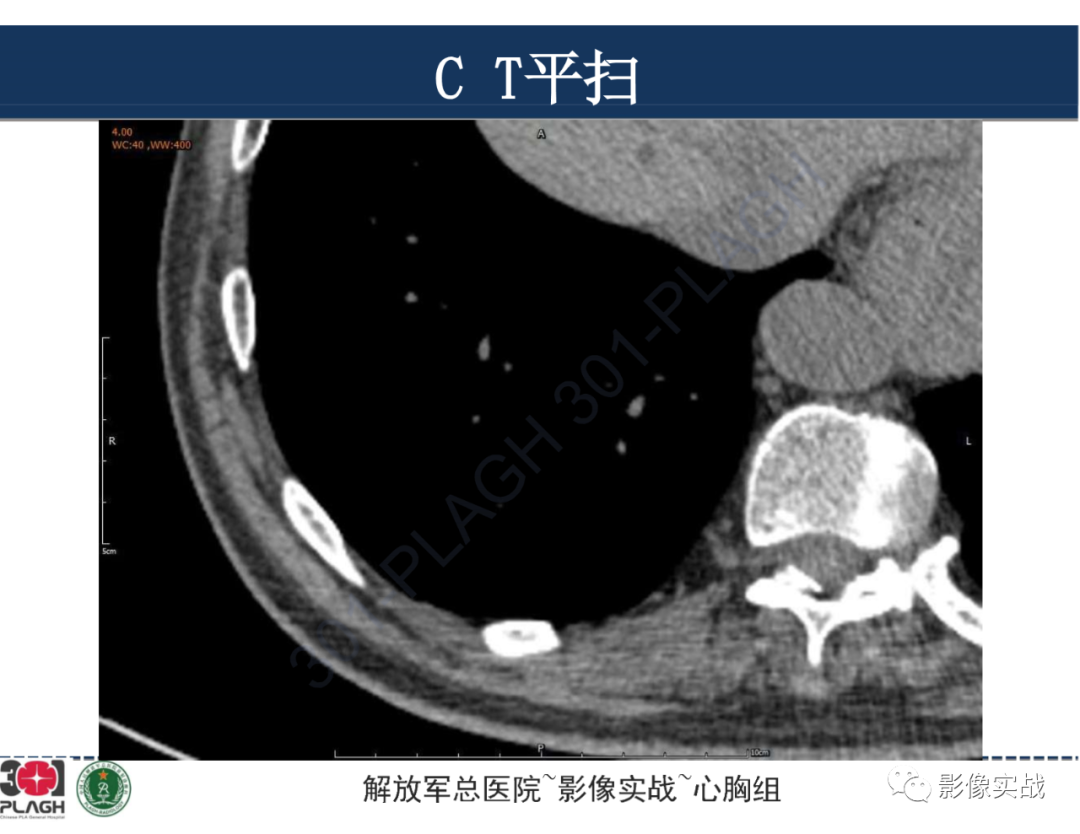 影像PPT - 【病例】肺浸润性腺癌1例CT影像-9